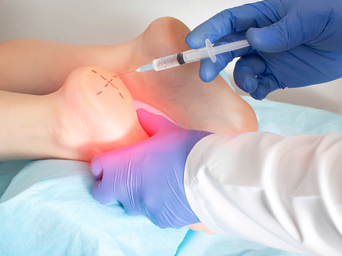 טיפול בדורבן ברגל